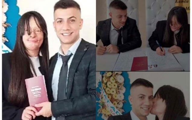 Üzünü yandırıb, onu kor edən adama ərə getdi - Fotolar